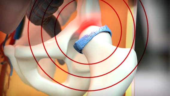 Schematische Darstellung: Hüftgelenk mit abgenutztem Knorpel und ausstrahlenden Schmerzen. © NDR 
