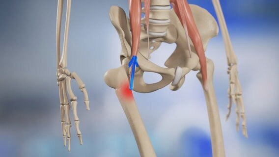 Schematische Darstellung: Ein verspannter Psoas-Muskel verursacht Schmerzen an der Knochennase © NDR 