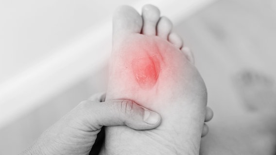 Hühnerauge am Fuß erzeugt Schmerzen. Symbolbild zeigt Fußsohle mit rotem Kreis, der Schmerz symbolisieren soll. © colourbox.de Foto: Andriy Medvediuk