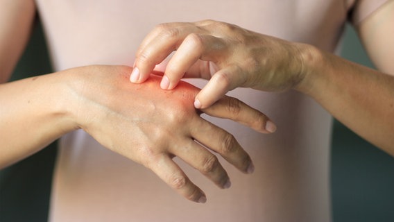 Eine Frau kratzt sich an einer Hand, der Bereich ist rötlich eingefärbt. © Panthermedia Foto: ridofranz