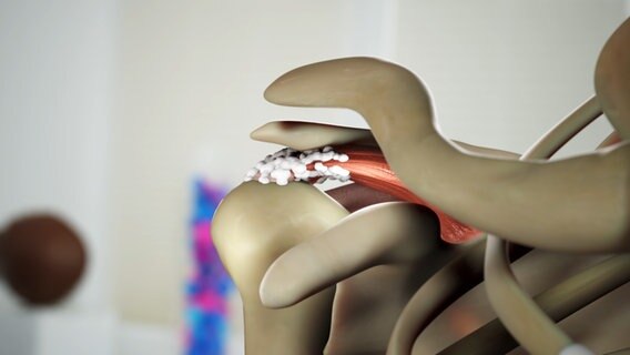Schematische Darstellung: verkalkter Sehnenansatz des Muskels in der Schulter. © NDR 