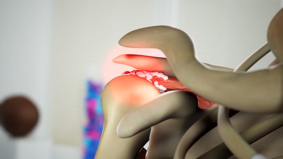 Schematische Darstellung: schmerzende Schulterspitze. © NDR 