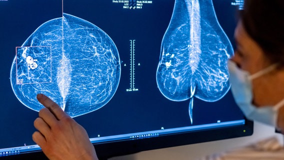 Medizinisches Personal untersucht mit einer Mammografie die Brust einer Frau auf Brustkrebs. © picture alliance Foto: picture alliance/dpa | Michael Hanschke