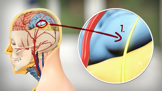 Schematische Darstellung des Kopfes mit Gehirn, Blutgefäßen und speziell mit einem Nerv. © NDR 
