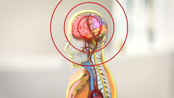 Schematische Darstellung: Schädel mit Gehirn, Schmerzwellen als pulsierende Kreise drumherum. © NDR Foto: tonic trix