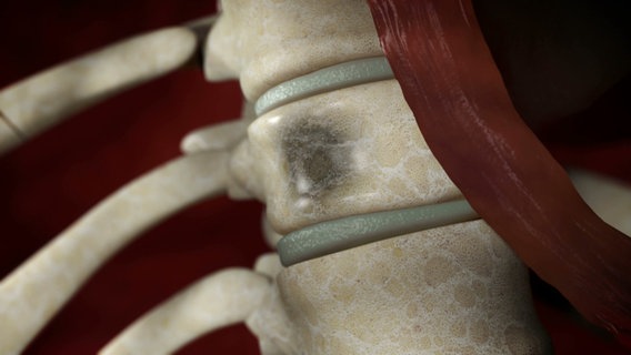 Durch ein Multiples Myelom entstehen schmerzhafte Löcher an den Knochen. © NDR 