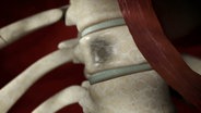 Durch ein Multiples Myelom entstehen schmerzhafte Löcher an den Knochen. © NDR 