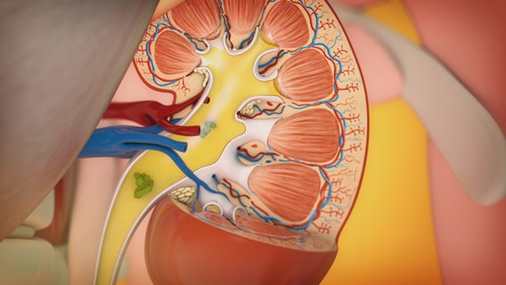 Schematische Darstellung: Niere mit Oxalat-Klumpen. © NDR 