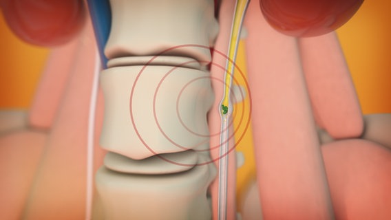 Schematische Darstellung: Kreise rund um Harnleiter symbolisieren Muskelkontraktionen. © NDR 