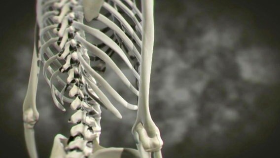 Fragen zu/über osteoporose steroide