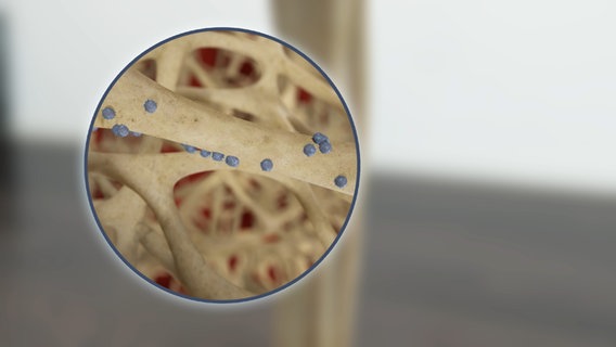 Schematische Darstellung: kleine Kügelchen im Knochengewebe. © NDR 