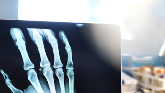 Hand im Röntgenbild  
