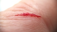 Bild zeigt Schnittwunde auf Haut einer Hand © colourbox.de 