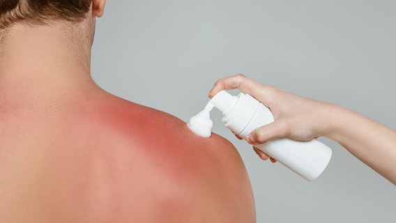 Auf eine Schulter mit Sonnenbrand wird ein kühlender Schaum aufgetragen. © PantherMedia Foto: IgorVetushko