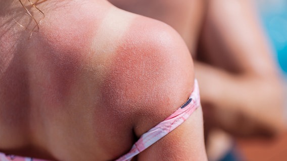 Schulter und Rücken mit Sonnenbrand © PantherMedia Foto: lia_russy