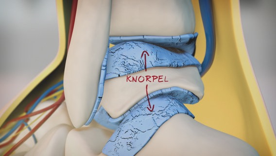 Schematische Darstellung: Knorpel wird spröde und fasert. © NDR 