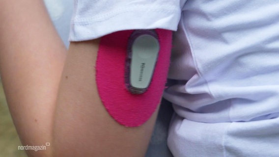 Ein Kind hat wegen Diabetes einen Sensor am Arm. © Screenshot 