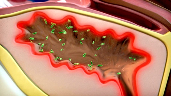 Schematische Darstellung: Bakterien heften sich an die Blasenschleimhaut © NDR 