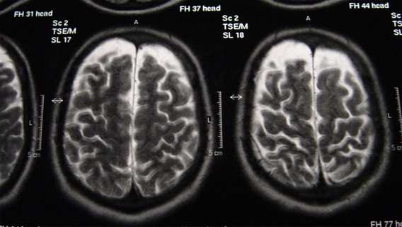 Kernspintomographie eines Gehirns. © photocase.de Foto: tac6