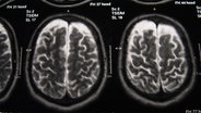 Kernspintomographie eines Gehirns. © photocase.de Foto: tac6