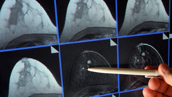 Diagnostik anhand einer Mammodraghie-Aufnahme © dpa/picture alliance Foto: Jan-Peter Kasper