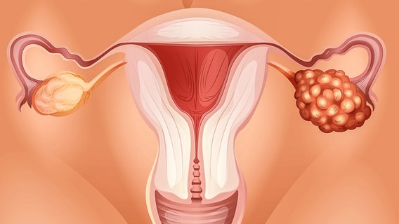 Eine Zeichnung von Eierstöcken, von denen einer mit Krebs befallen ist. © panthermedia Foto: blueringmedia
