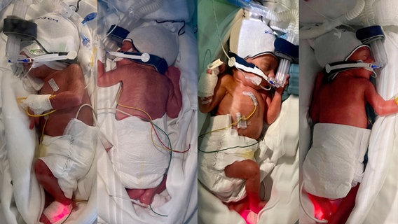Die vierlinge Aman, Awan, Arina und Arin nach der Geburt im AK Altona. © Asklepios 