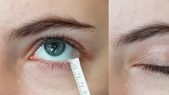 Tränenflüssigkeitstest bei Probandin mit der Pipette am Auge (nah) © Nationales Referenzzentrum für Transmissible Spongiforme Enzephalopathien 