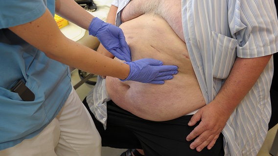 Eine Person in medizinischer Kleidung und Handschuhen tastet bei einem sehr übergewichtigem Mann den Bauch ab. © fotolia.com Foto: David Ebener