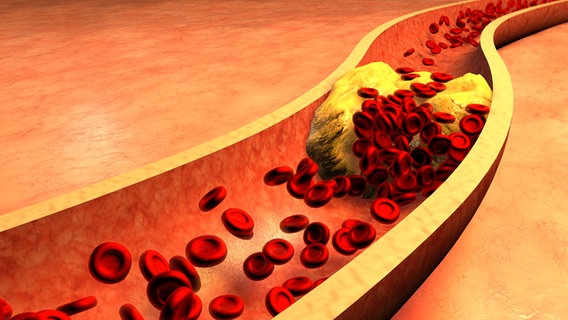 Verstopfte Arterie mit Blutplättchen und Cholesterin-Plaque dargestellt in einer Grafik. © panthermedia Foto: ralwel
