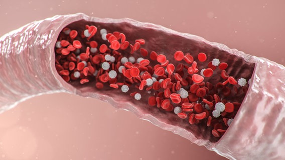 Eine Arterie, durch die rote Blutplättchen fließen und bei der weiße Plaques für die Verkalkung der Arterie sorgen. © colourbox Foto: -