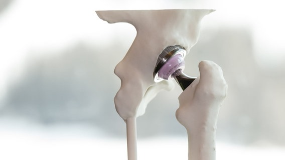Ein künstliches Hüftgelenk ist ein Skelett-Modell eingebaut. © picture alliance / Johann Groder / EXPA / picturedesk.com | Johann Groder 