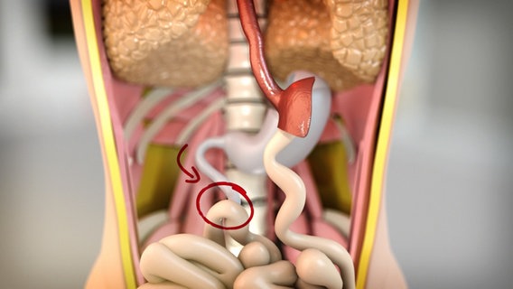 Schematische Darstellung: Darmschlingen im unteren Bauch, davon eine eingekreist. © NDR 