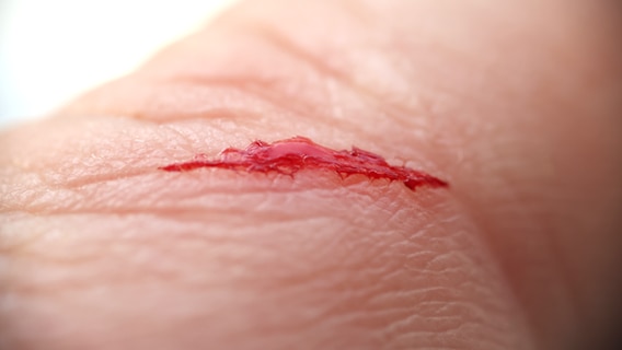Bild zeigt Schnittwunde auf Haut einer Hand © colourbox.de 