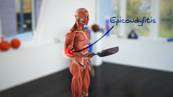 Schematische Darstellung: Muskel-Menschenmodell mit Bratpfanne in der Hand und schmerzrotem Ellenbogen. © NDR 