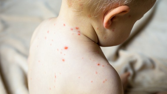 Ein Kleinkind mit roten Pusteln auf der Haut. © Panthermedia Foto: grinvalds
